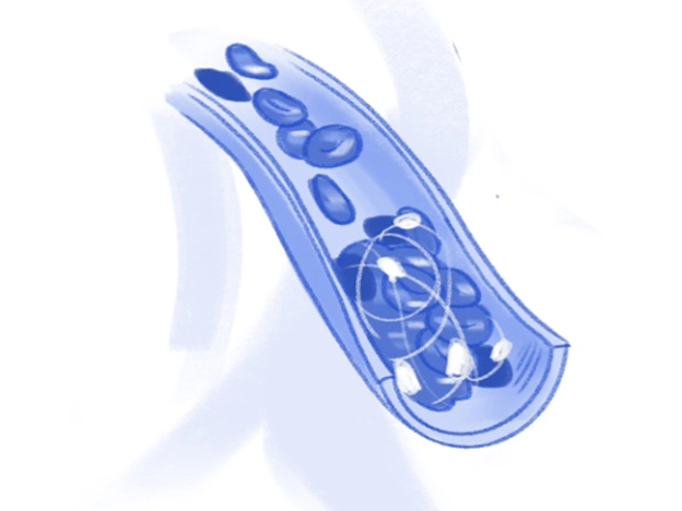 Sketch of blood clot in the cross-section of a blood vessel