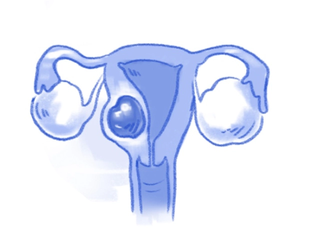 Sketch of a mass in the wall of the uterus