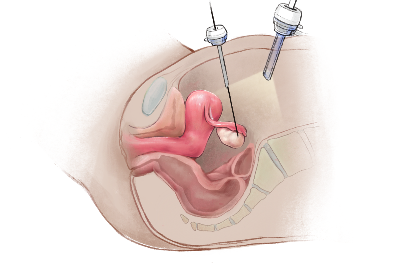 Sagittal cross-section of the abdomen and pelvis depicting a laparoscopic oocyte retrieval