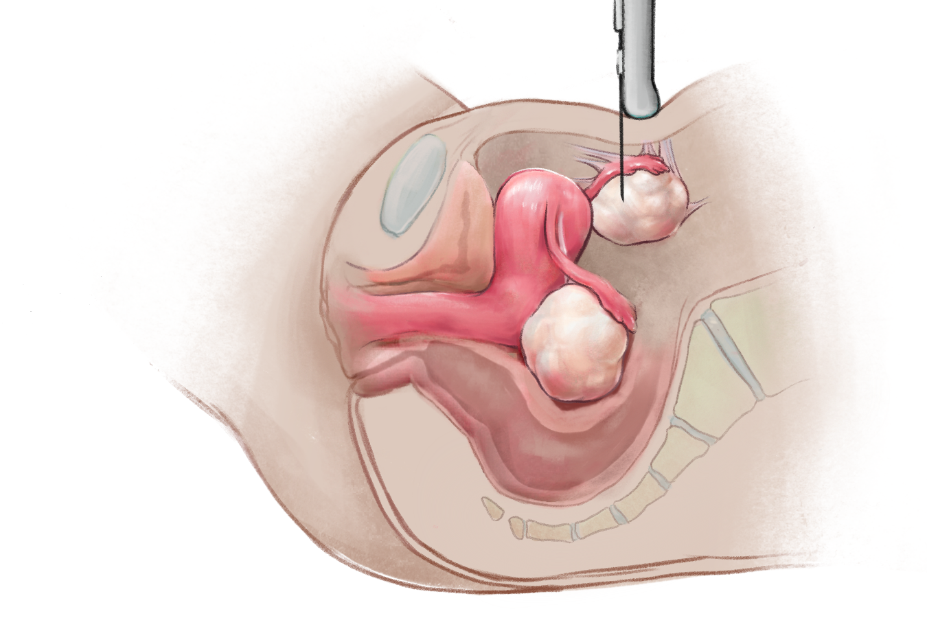 Sagittal cross-section of the pelvis region depicting a transabdominal oocyte retrieval