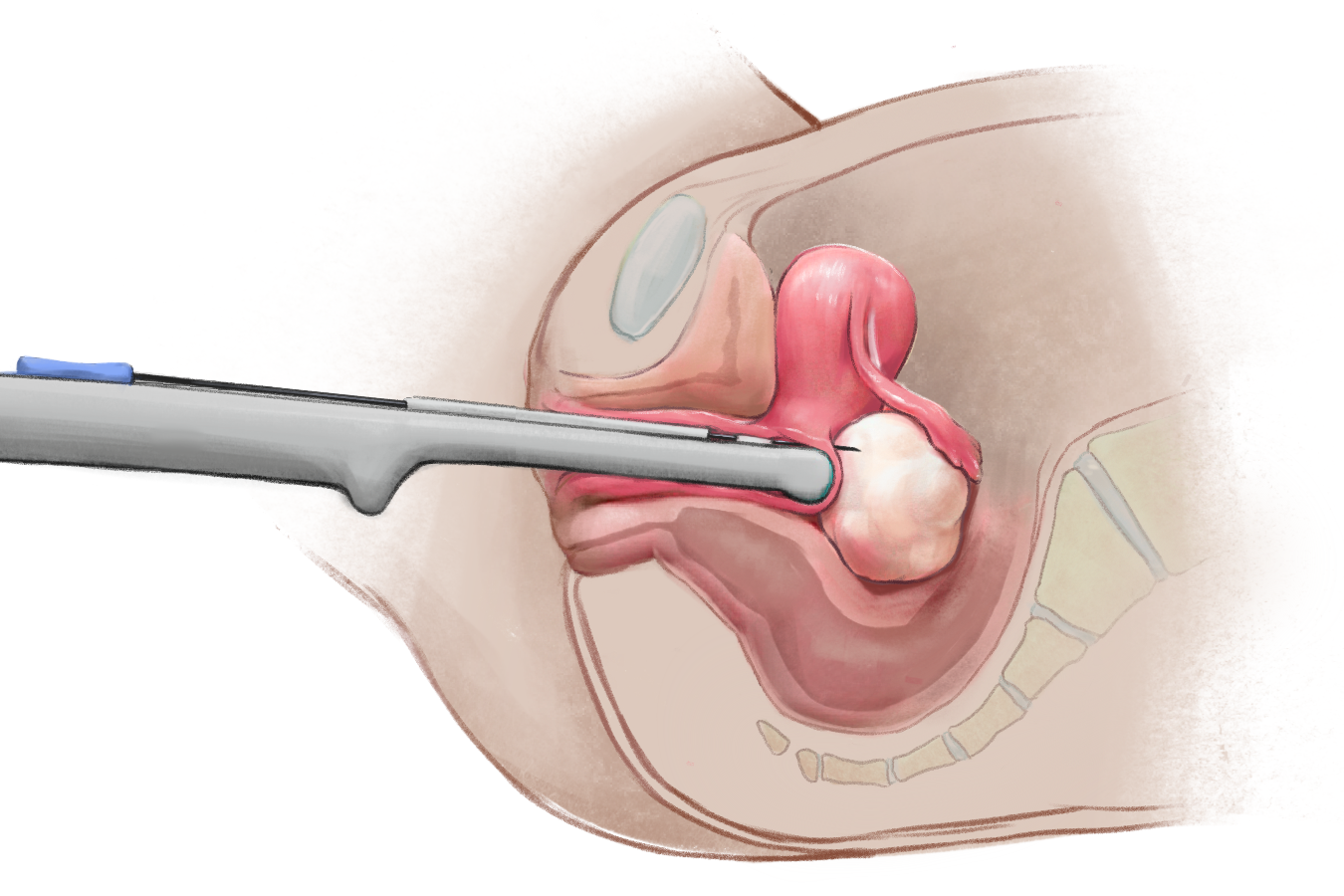 Sagittal cross-section of the pelvic region depicting a transvaginal oocyte retrieval
