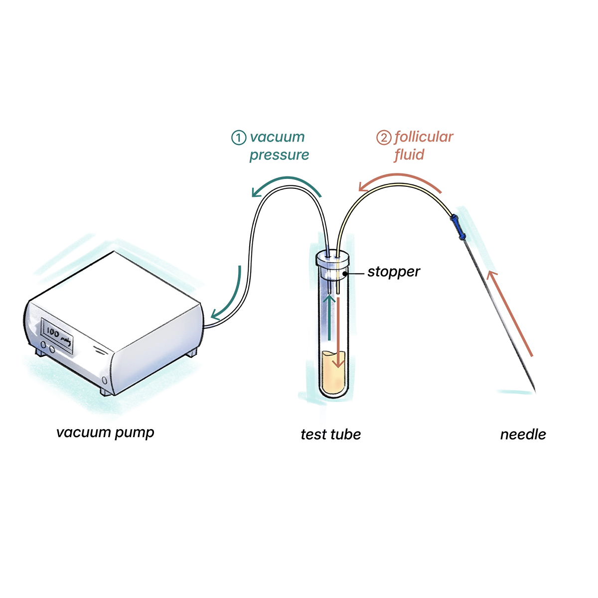 Aspiration circuit diagram with vacuum pump, test tube, rubber stopper, and needle. Arrows indicate the flow of follicular fluid from needle to test tube.