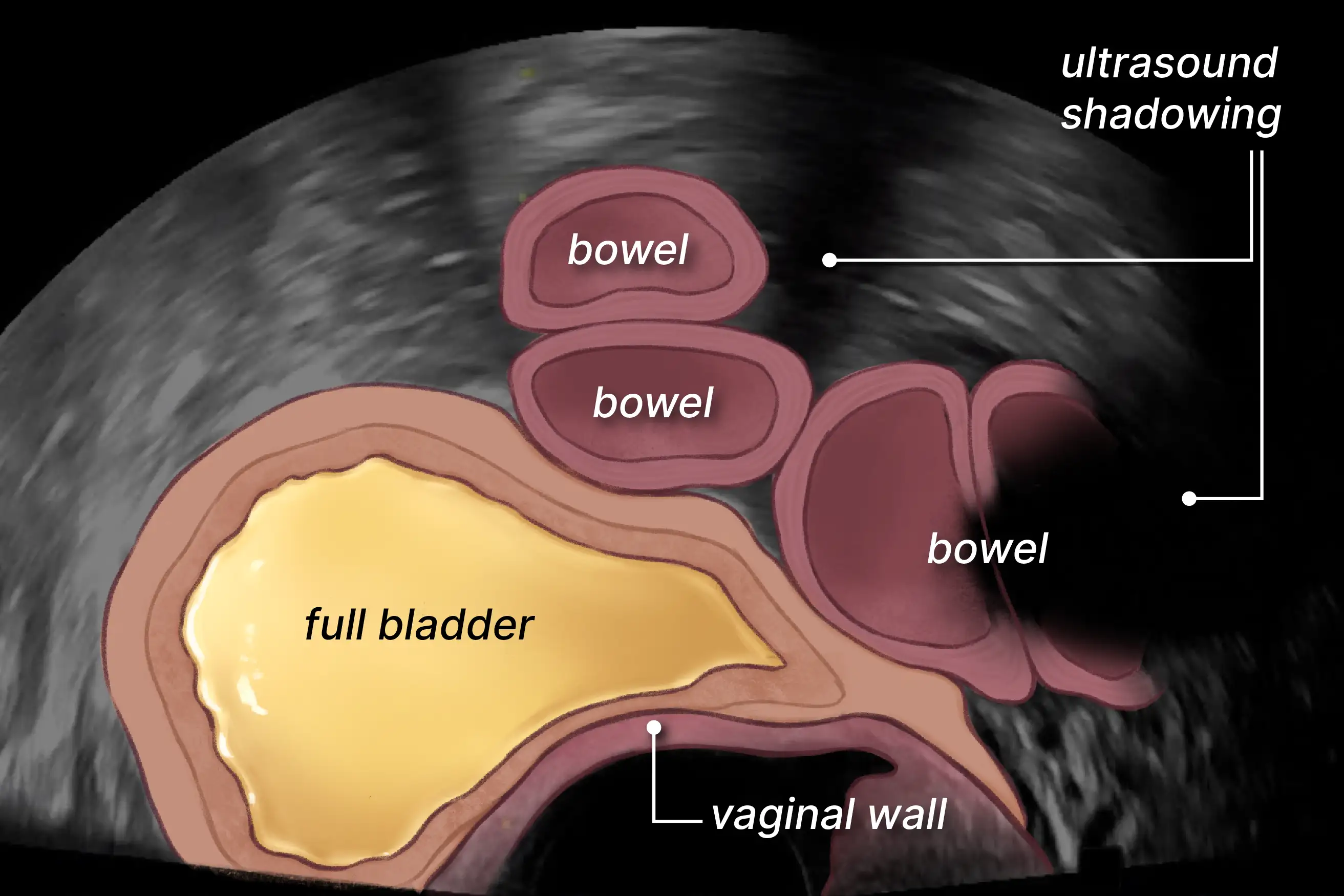 Labelled illustration of bladder and bowels.
