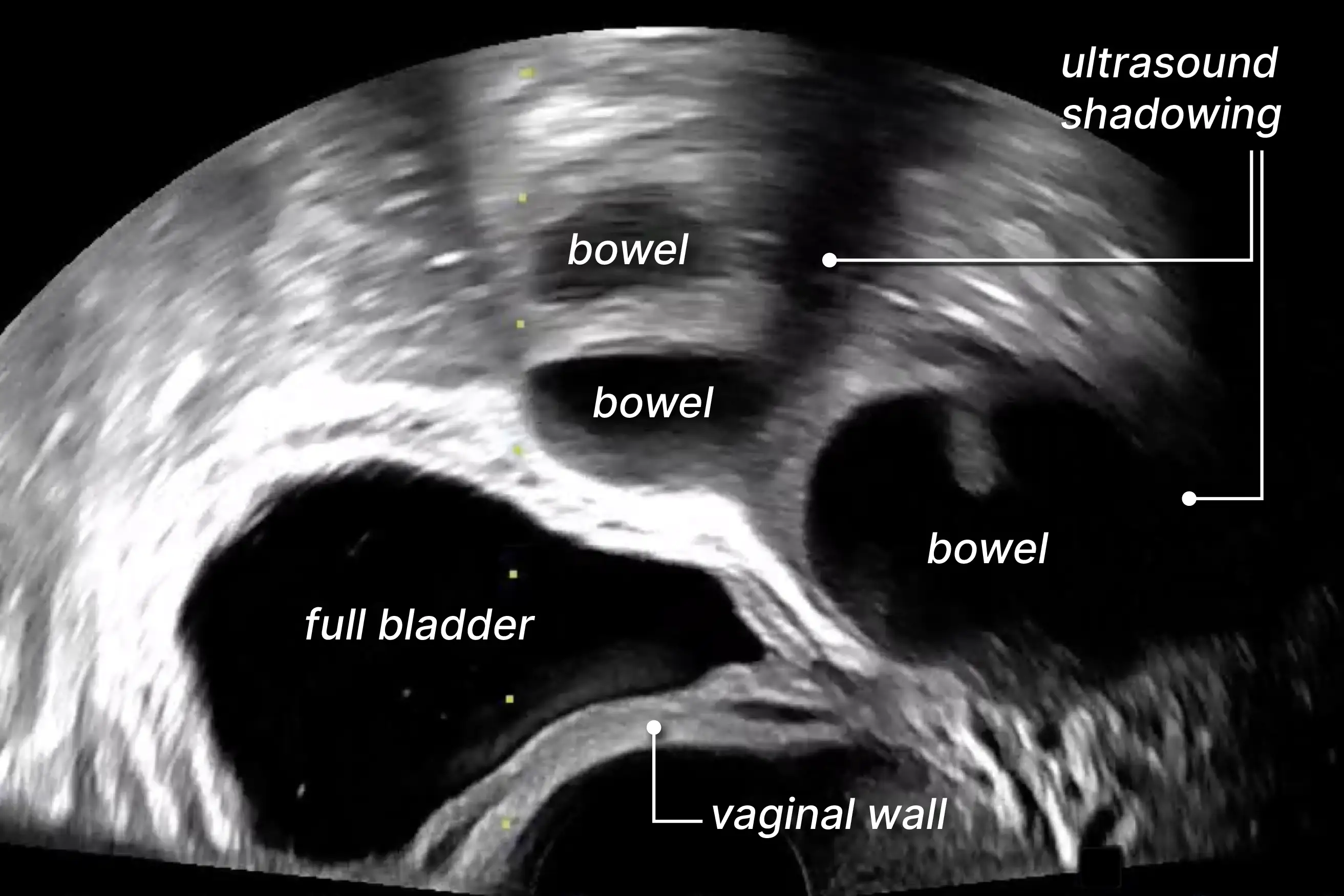 Labelled ultrasound showing bladder and bowels.