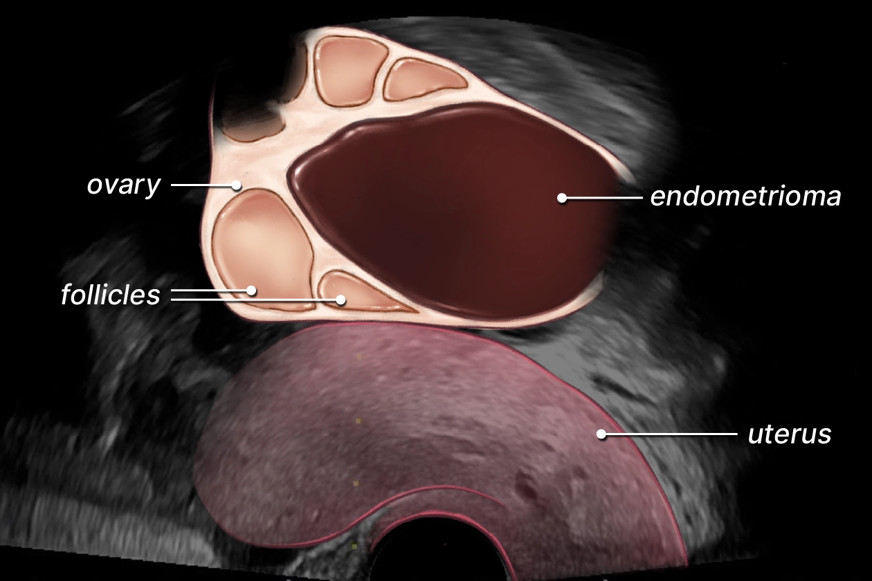 Labelled illustration of an endometrioma in the ovary.
