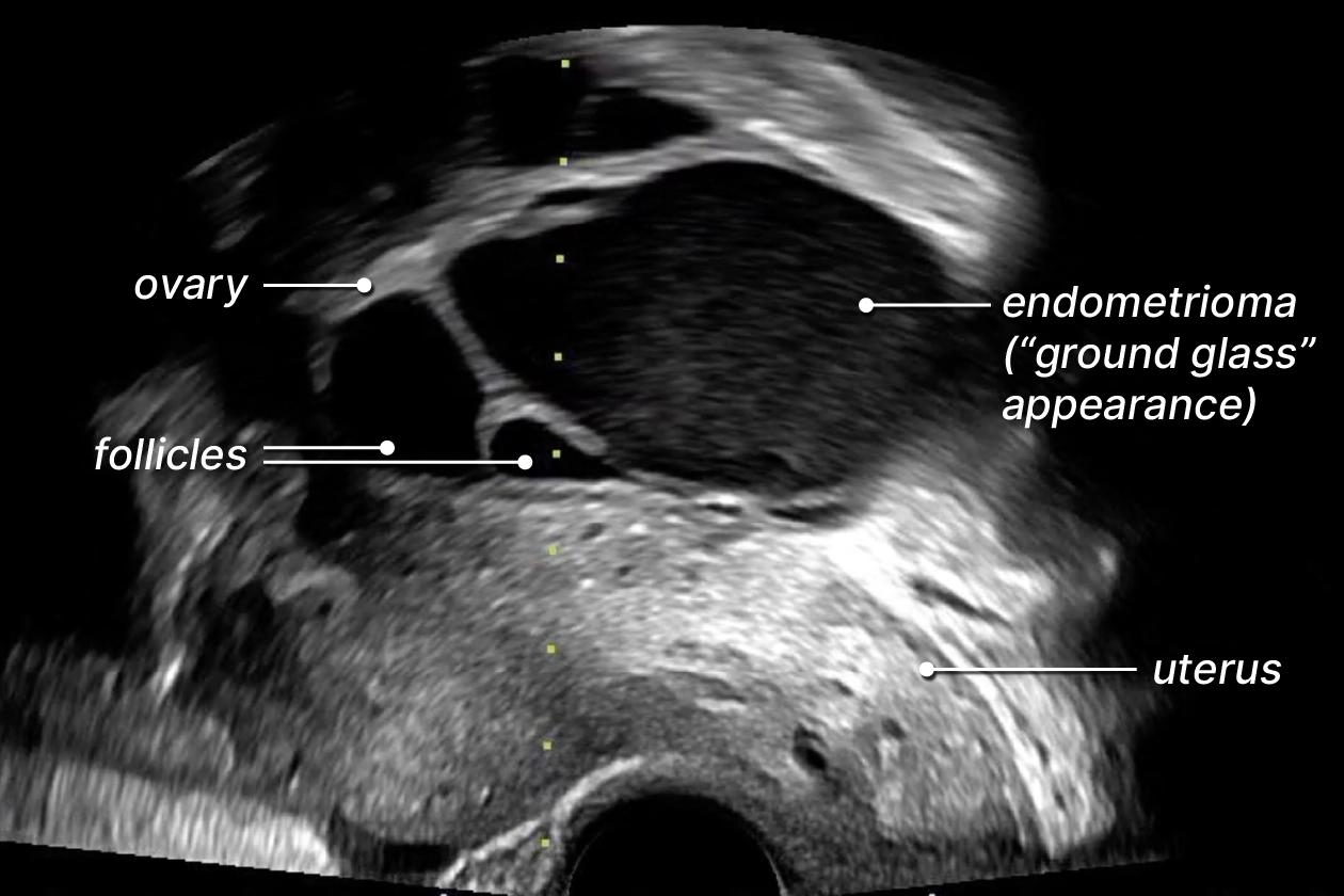Labelled ultrasound of an endometrioma in the ovary.