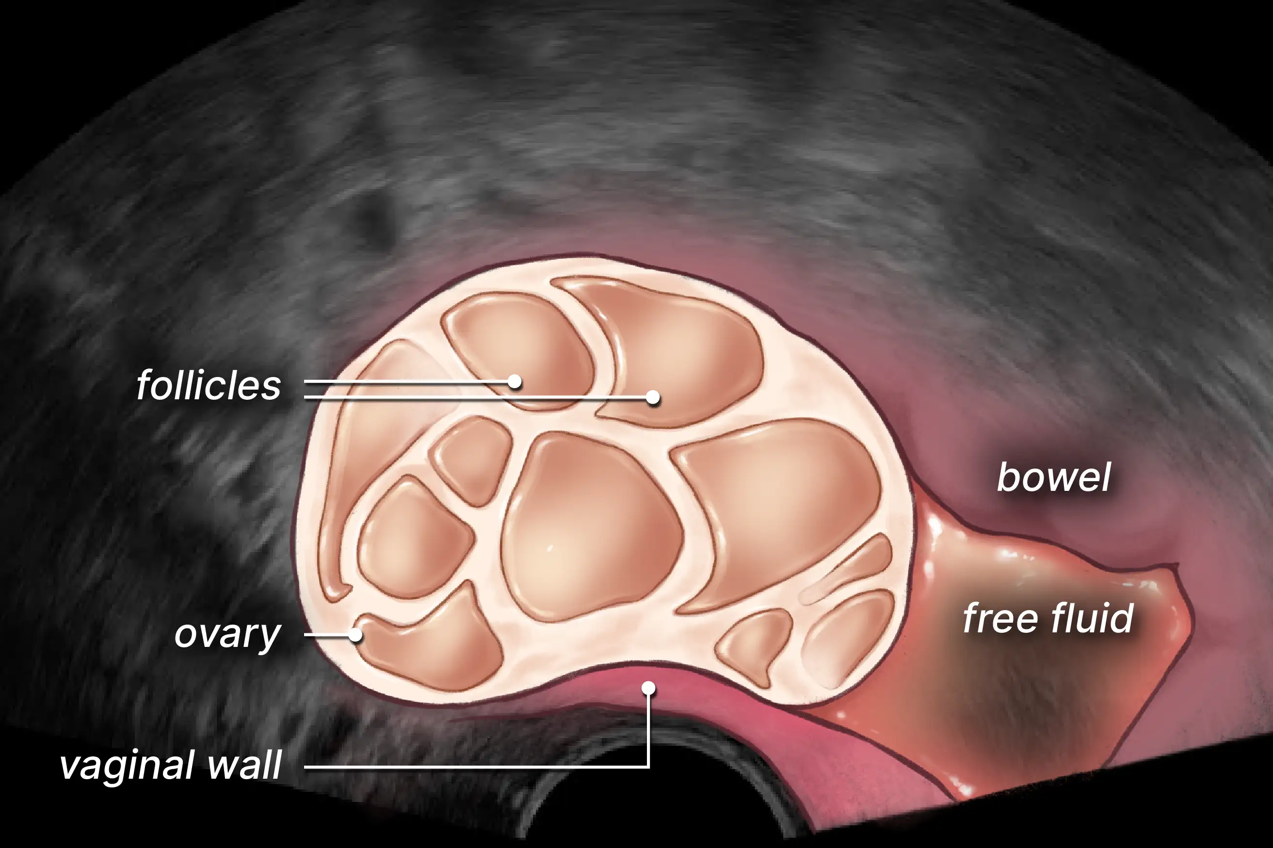 Labelled illustration of free serous fluid in the rectouterine pouch of the pelvis.