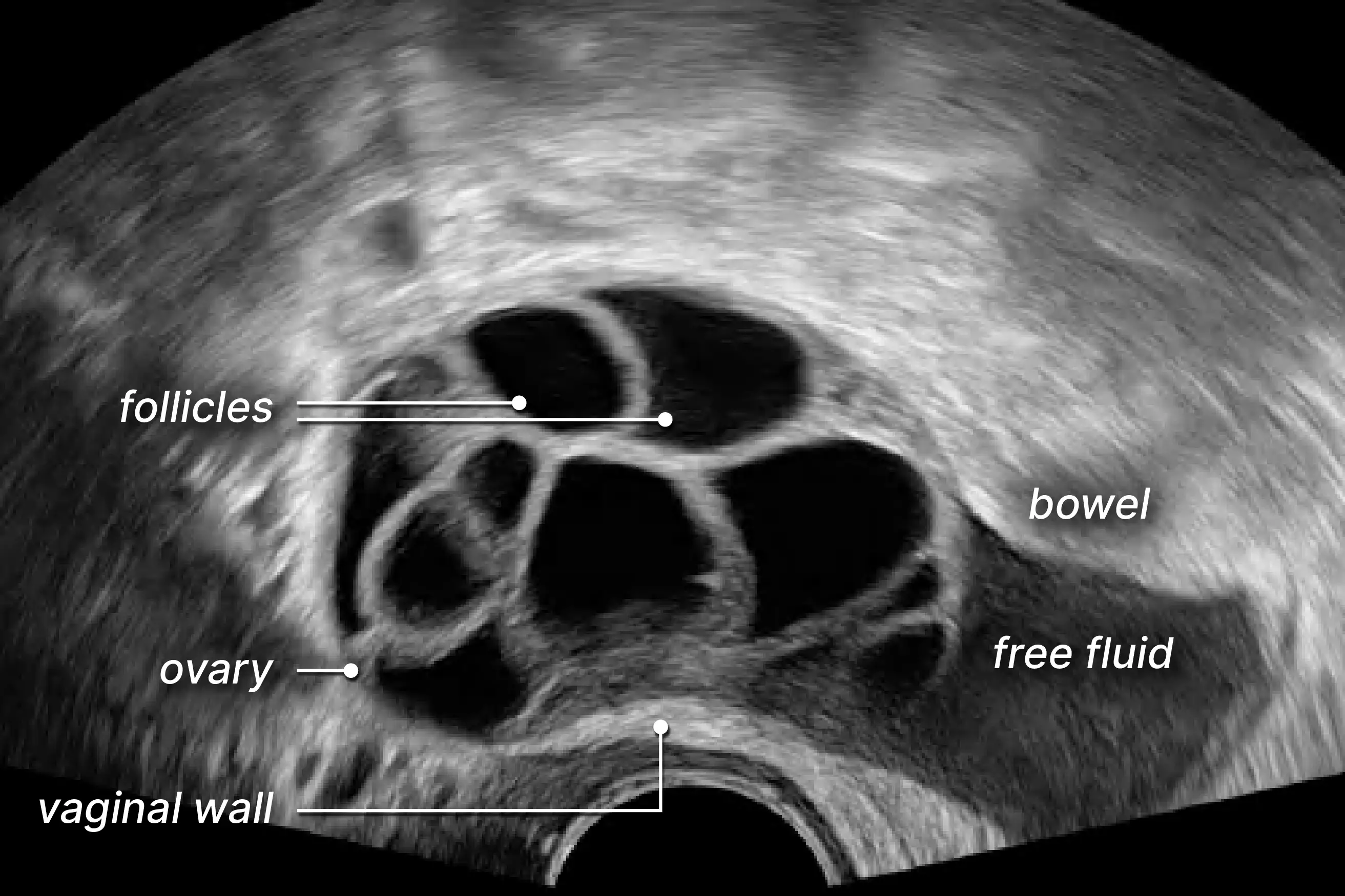 Labelled ultrasound of free serous fluid in the rectouterine pouch of the pelvis.