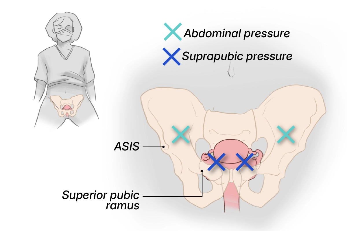Diagram of pelvis and uterus showing landmarks for applying abdominal pressure.