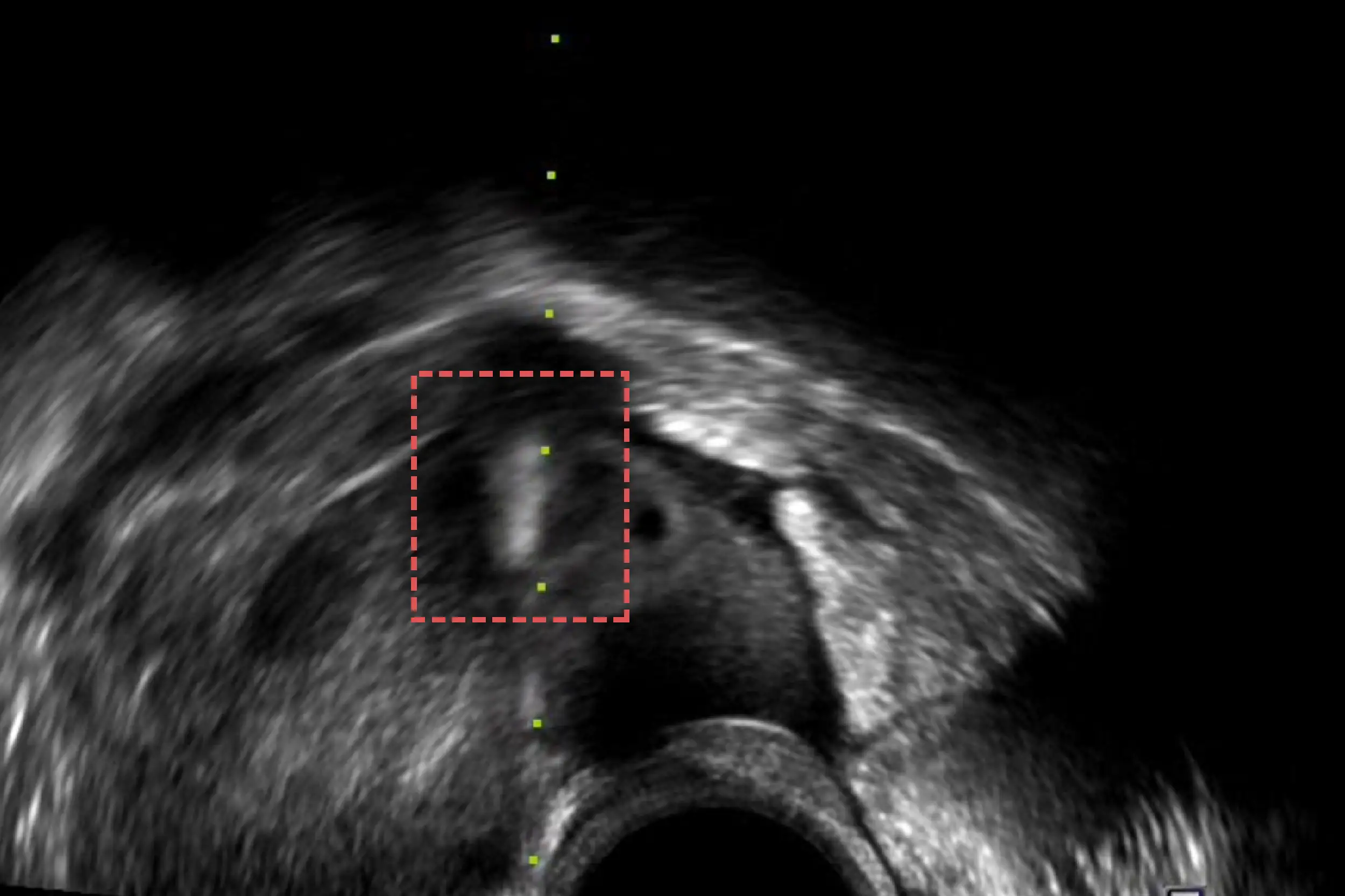 Example of a blurry, poorly visualized needle.