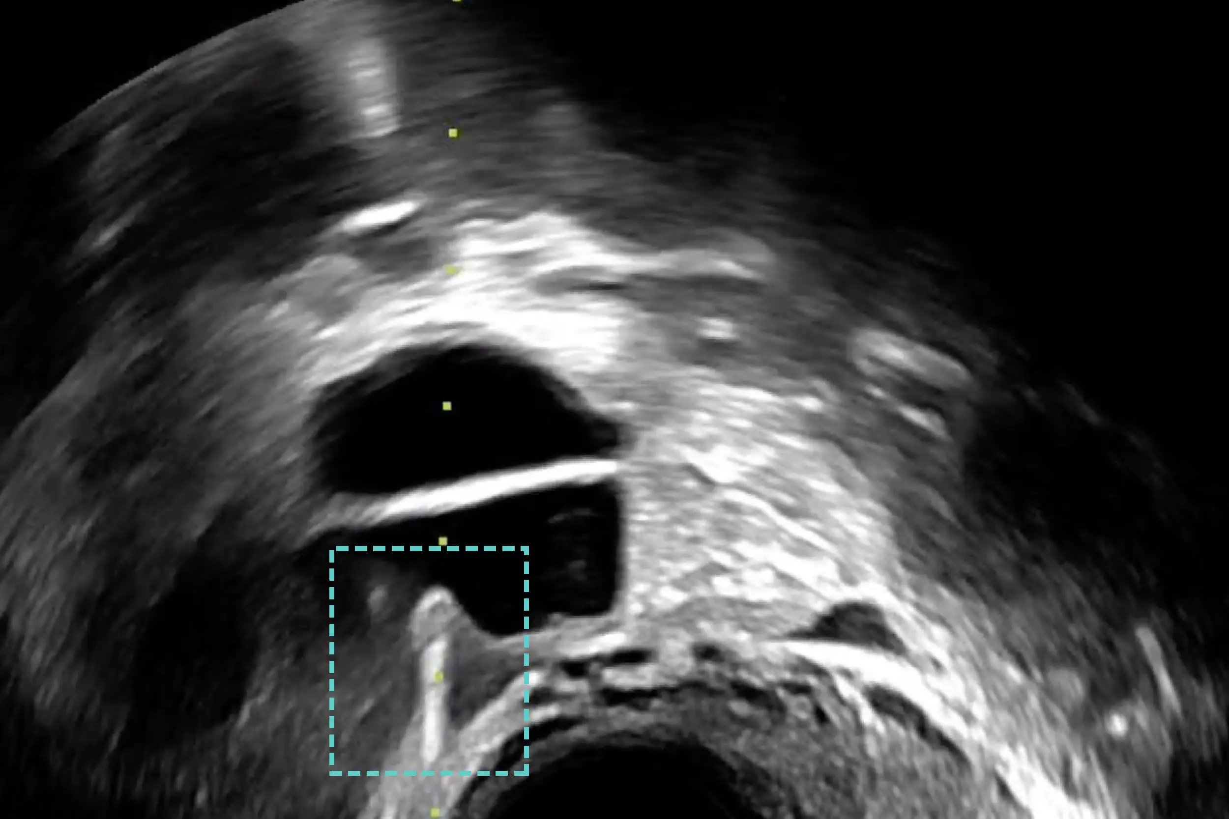 Example of a clear, well-visualized needle.