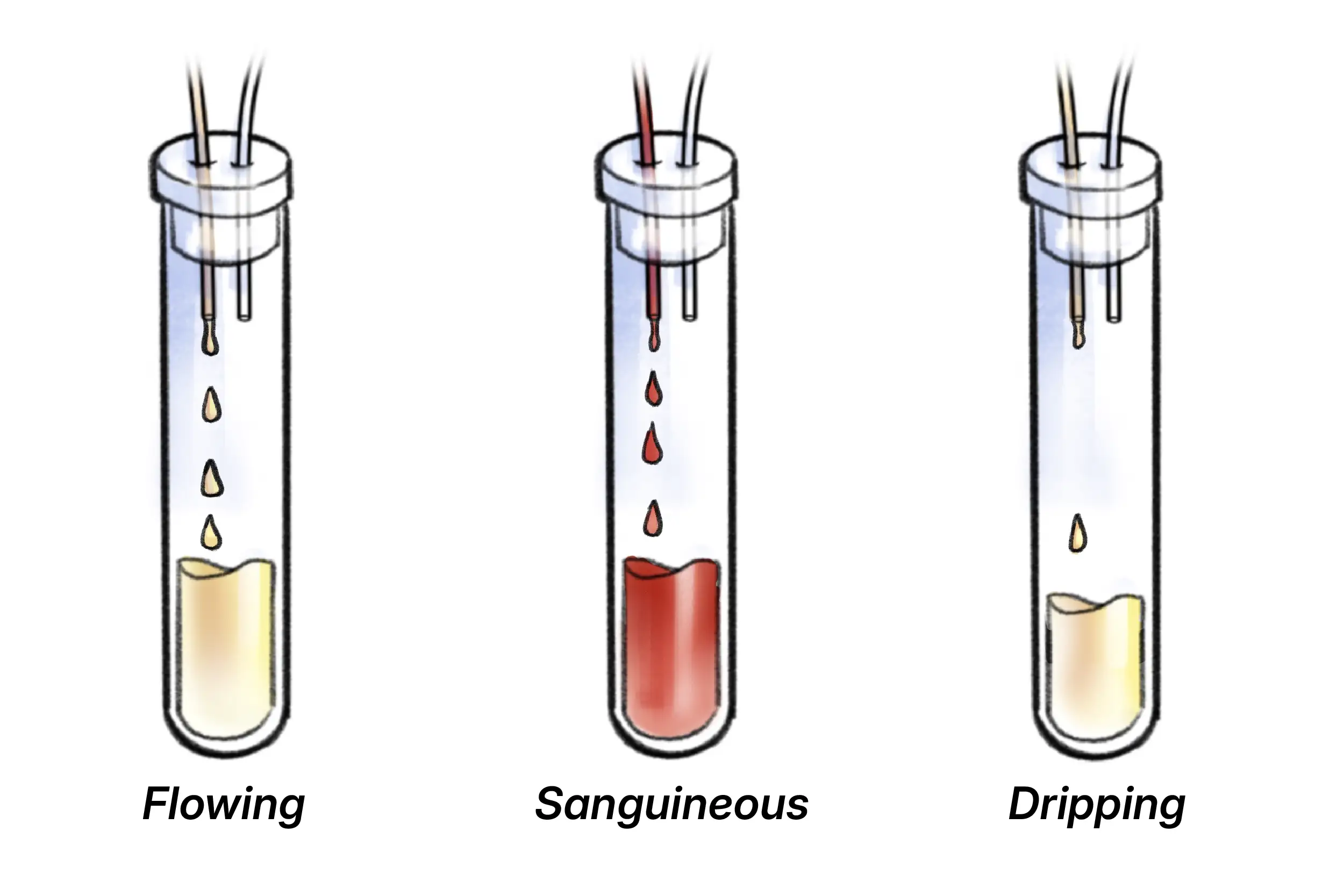 Illustration of optimal follicular fluid colour and flow.