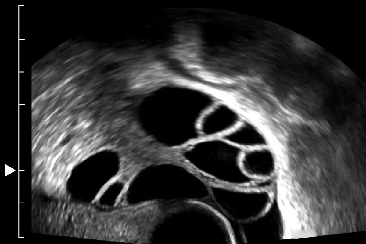 Example of focus depth closer to the center of the ovary.