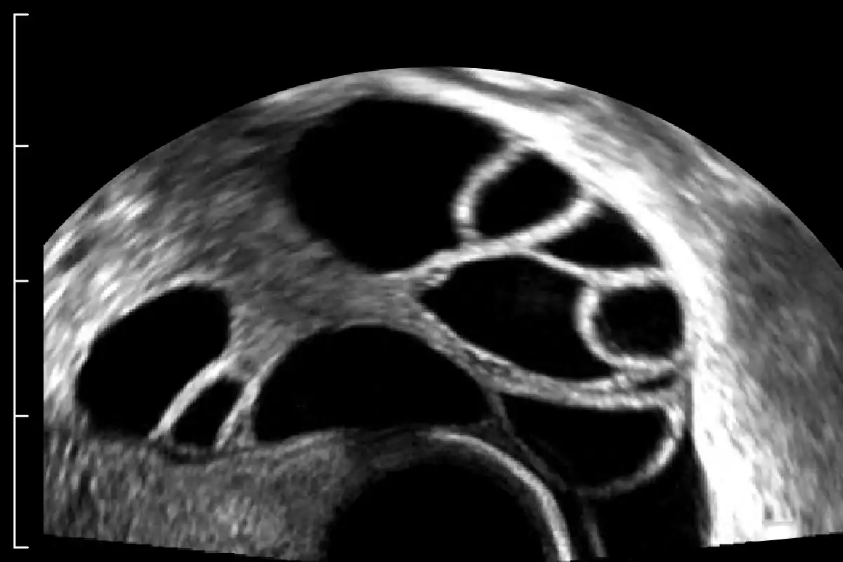 ultrasound image showing decrease of depth setting