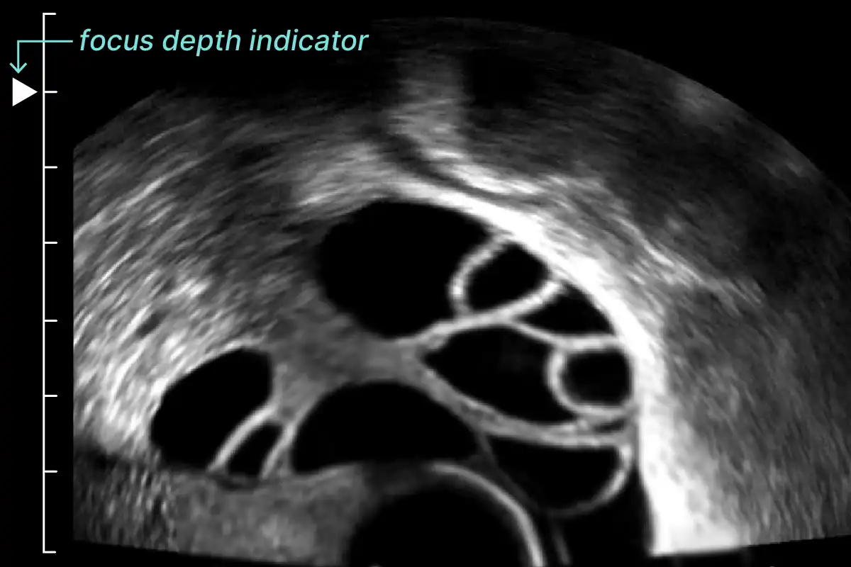 Example of focus depth deeper beyond the ovary.