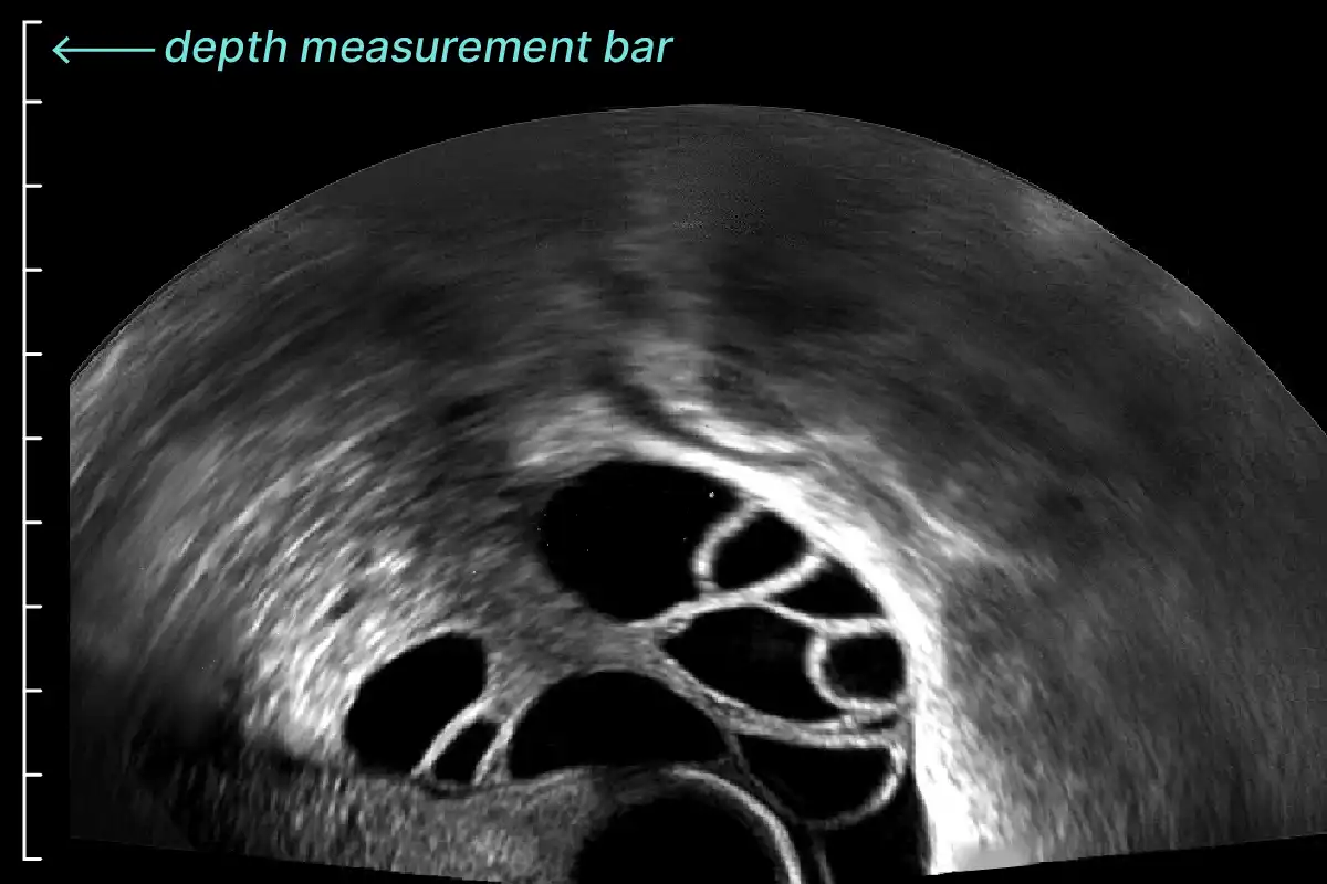 ultrasound image showing increase of depth setting