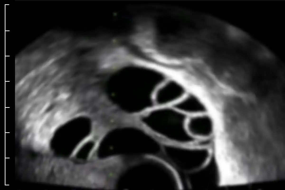 Example of low-resolution ultrasound.