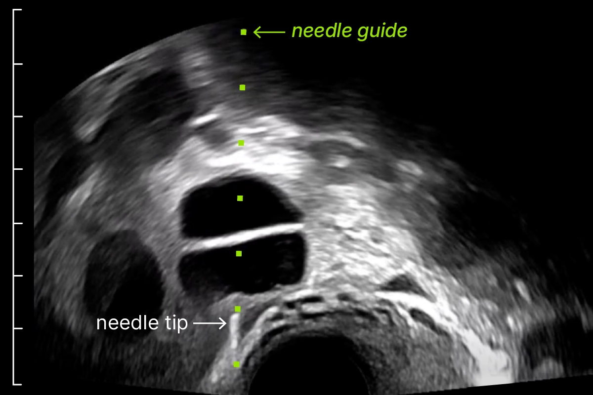 Example of needle guide track.