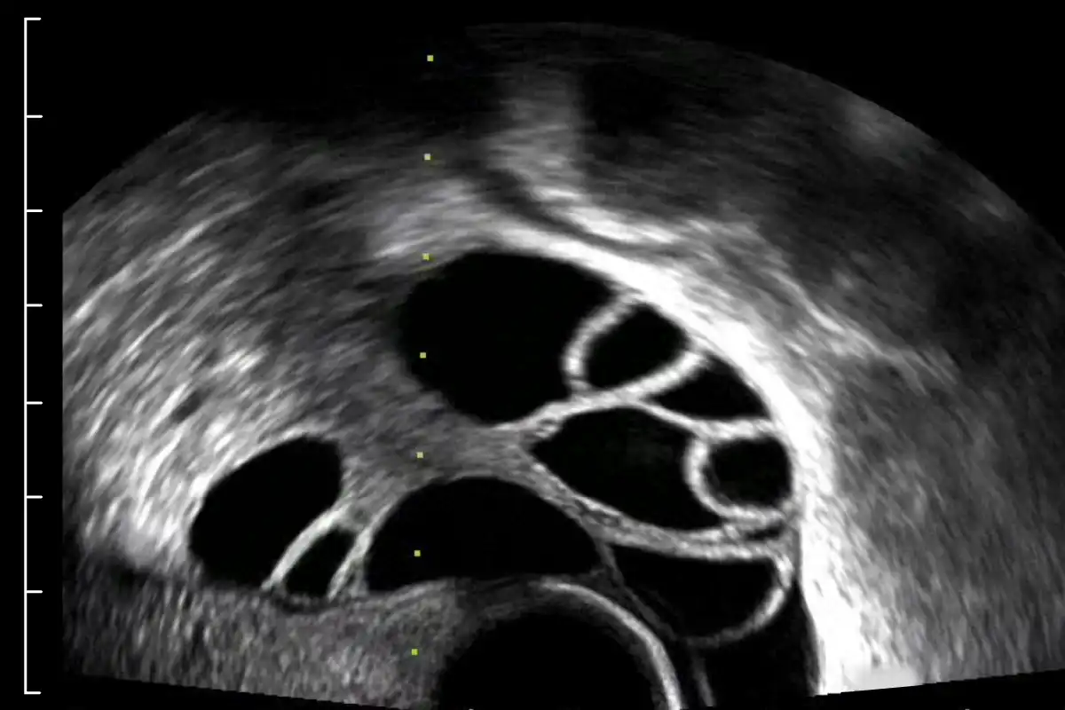 Example of optimal ultrasound gain.