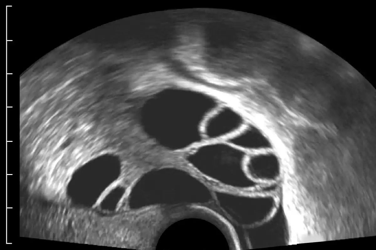 Example of over-gained ultrasound.