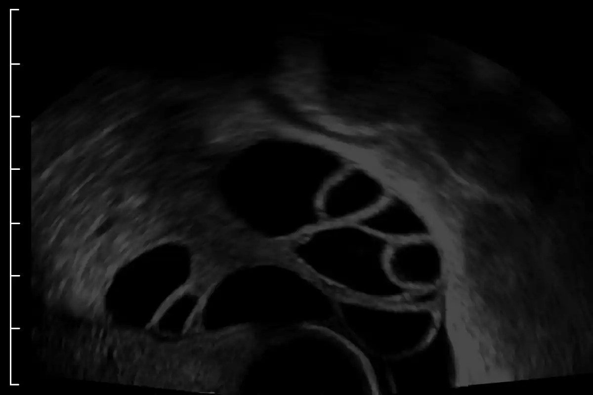 Example of under-gained ultrasound.