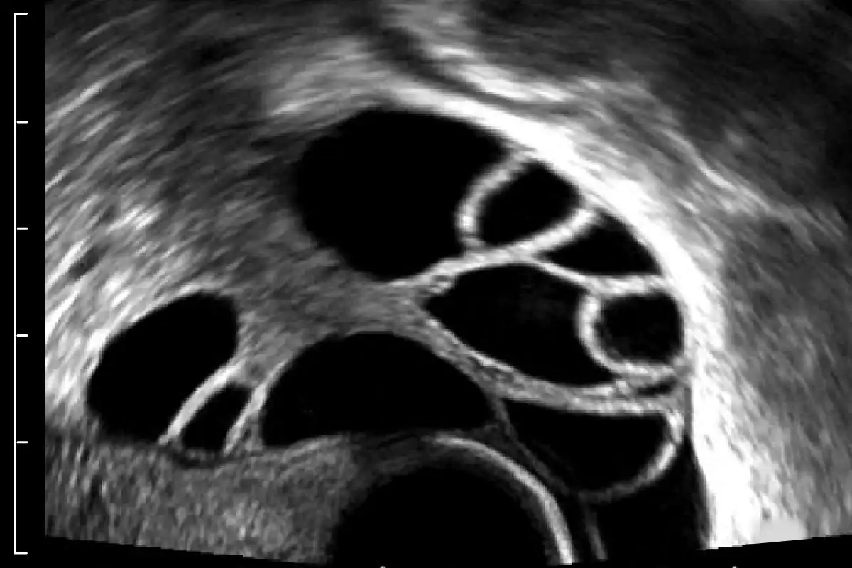 ultrasound image showing zoom in