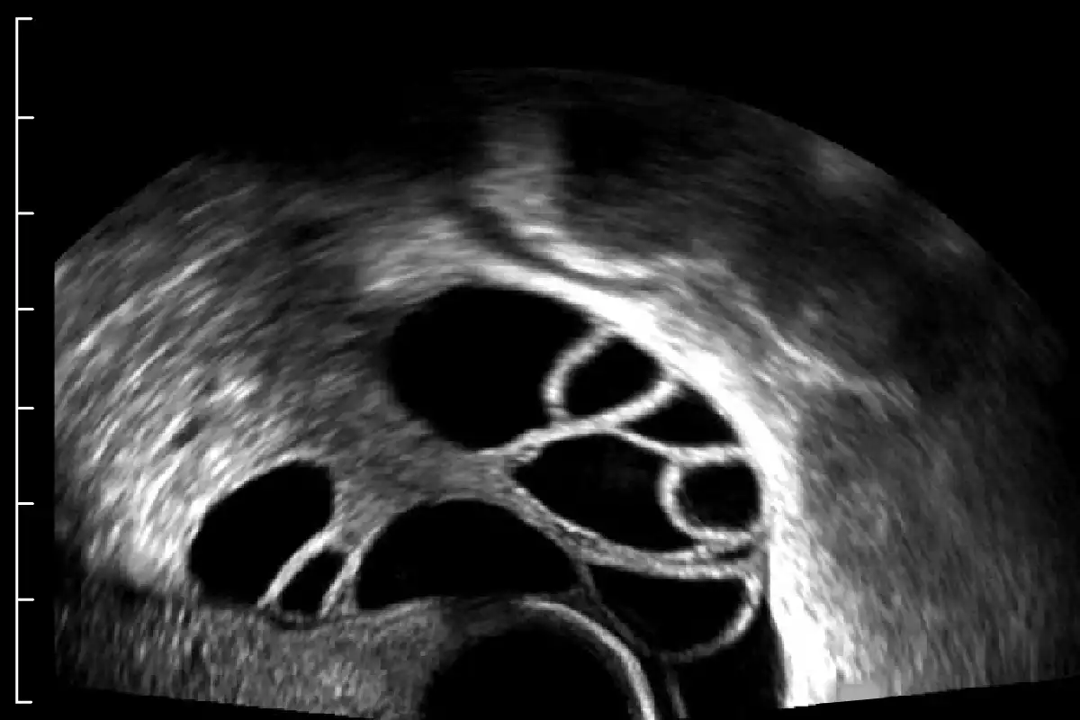 ultrasound image showing zoom out